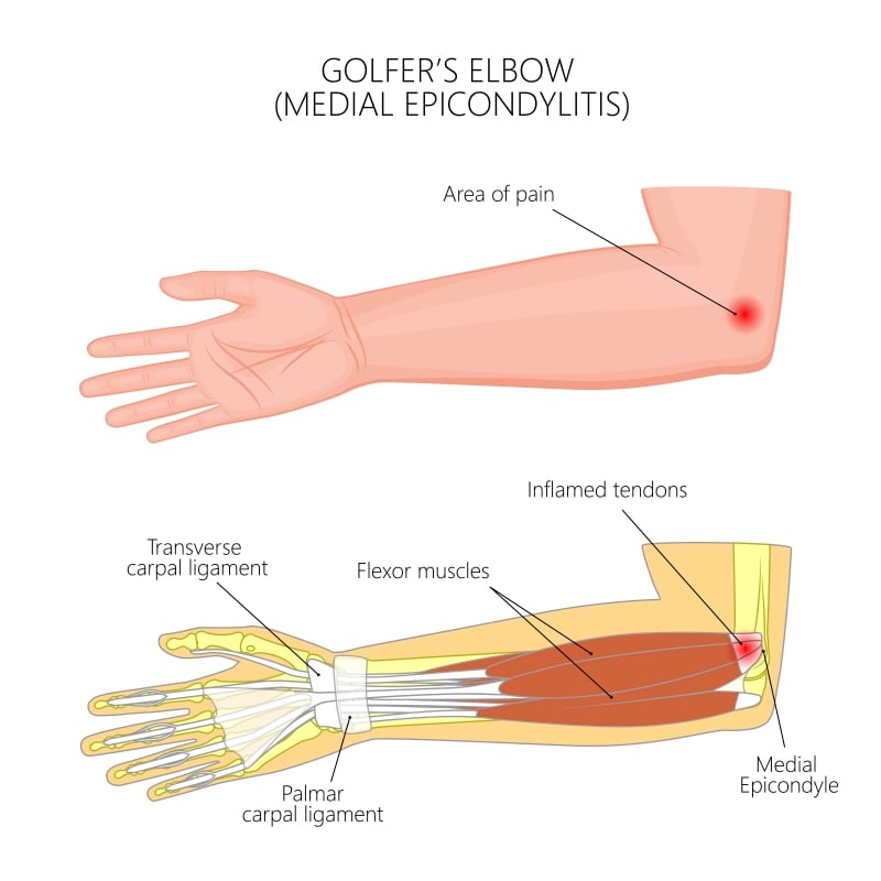 How to treat golf elbow