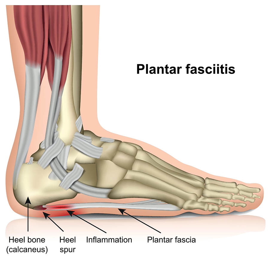 Best Golf Shoes for Plantar Fasciitis 5